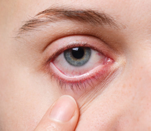 I sintomi della sindrome dell'occhio secco - Poliambulatorio PCM