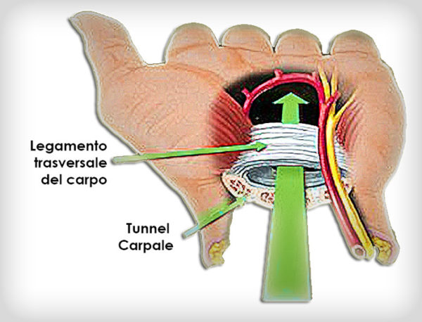 Sindrome del tunnel carpale