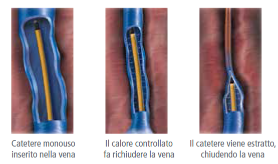 tecnica radiofrequenza - chirurgia vascolare Poliambulatorio PCM radiofrequenza vene