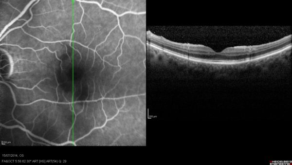 OCT + FAG Pucker maculare