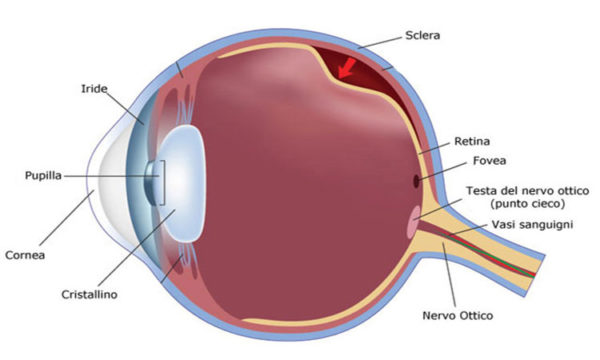 distacco di retina