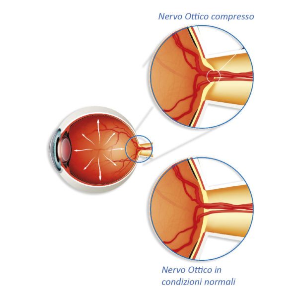 Glaucoma