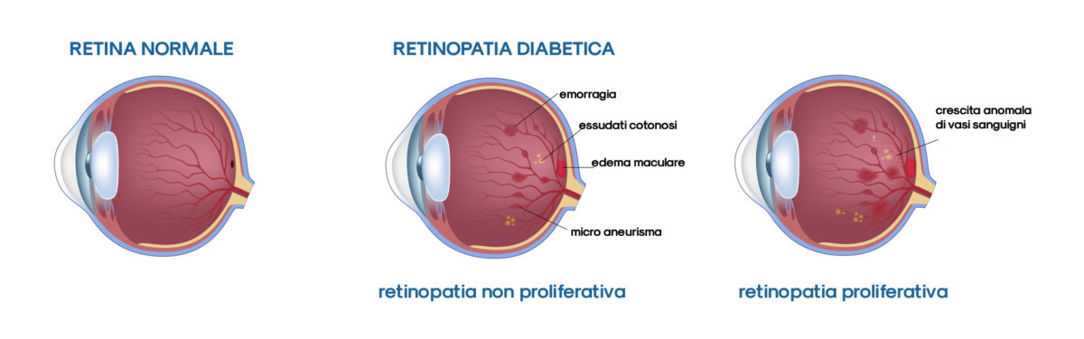 retinopatia diabetica