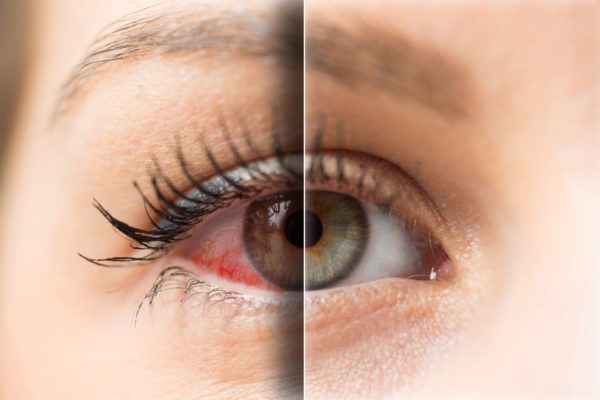 Sindrome da Occhio Secco