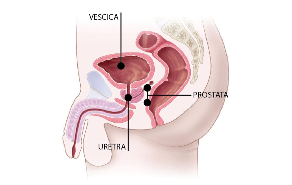 poli si prostatita prostatic adenoma causes