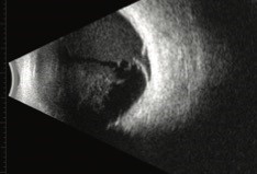 Immagine Bscan di una rottura retinica con distacco di retina circostante ed emorragia vitreale