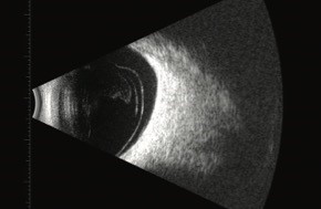 Immagine Bscan di un distacco posteriore di vitreo con evidente separazione della jaloide posteriore