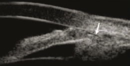 Immagine UBM di un iride plateau con angolo molto stretto